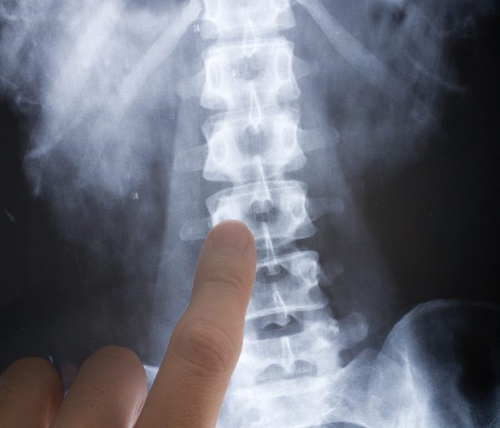 An X-ray of a human spine with a hand pointing to a disc
